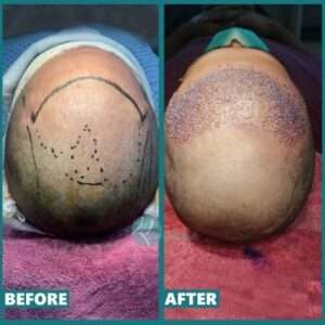 Hair-Transplant-Surgery-in-Lahoreclinic-pnlb5elzzbx05ybqvm0f9d8viqwyknp4omkew2dyu8-1-300x300