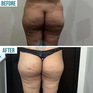 Liposuction-6-300x300